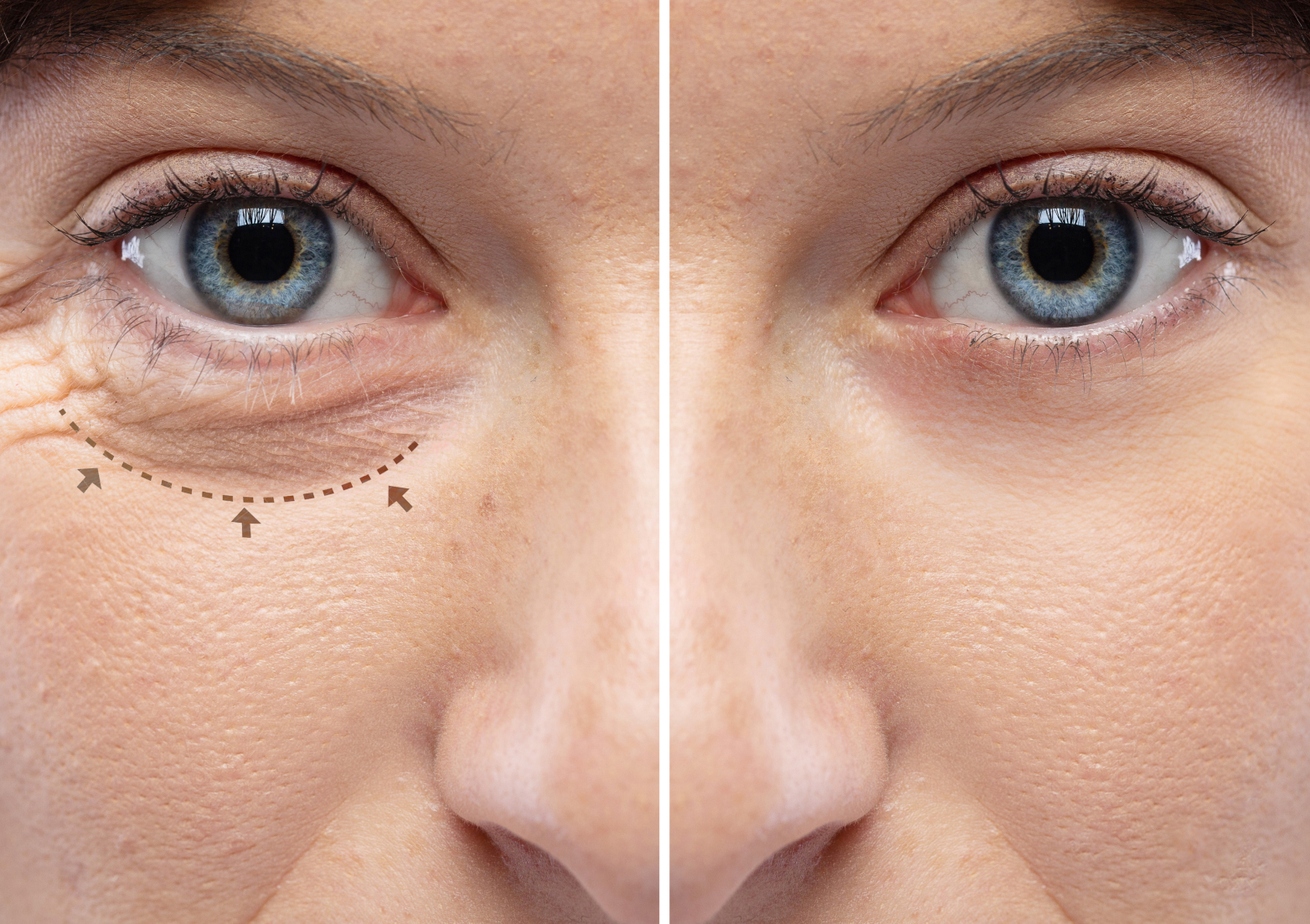 blefaroplastia-gyn